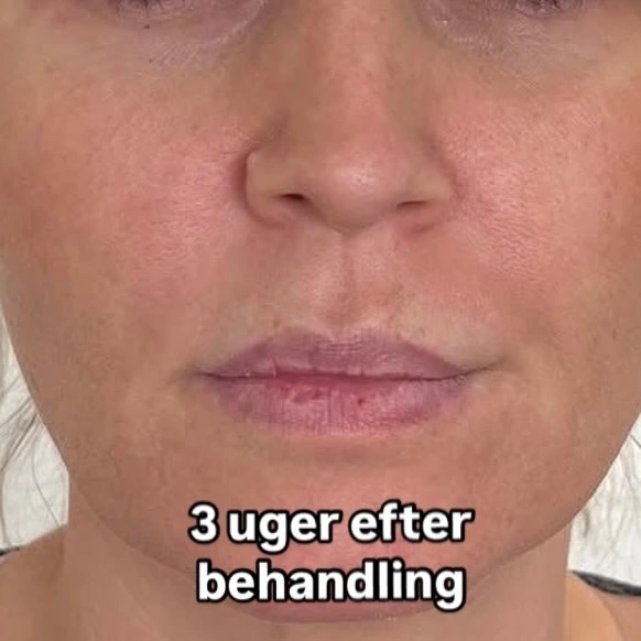 Fillerbehandling
