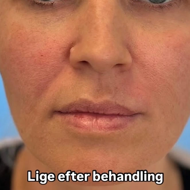 Filler behandling