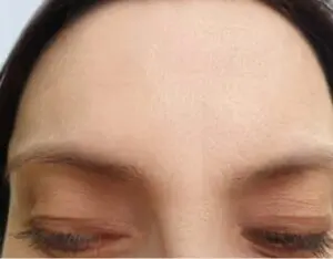 Panderynker efter Botox
