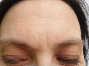 Panderyner før Botox