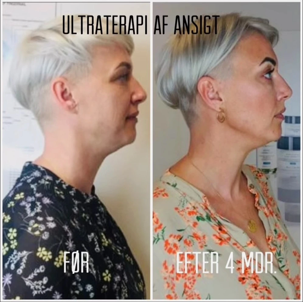 Før og efter opstramning af ansigt og hals med sikker og professionel ultralydsterapi.